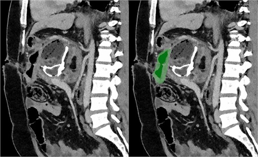 Sagittal section of post-operative CT with portal venous contrast demonstrating cystojejunustomy, highlighted in green, anastomosed to the origin of the fistula.
