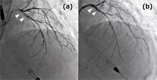 (a) Coronary angiography (CAG) before PCI: the white arrows indicate culprit lesions; (b) CAG post PCI: the white arrows indicate the treatment area.