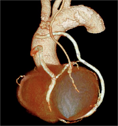 Postoperative 3D CT image showing the bypass graft design.