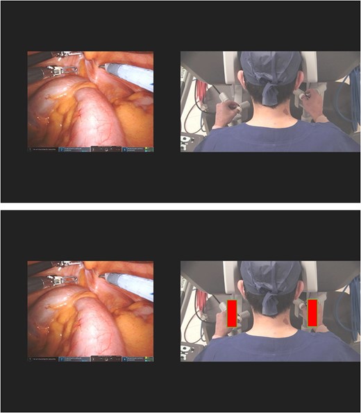 Concurrent videotaping of intraoperative case and surgeon at the robotic console (with central position outline marked in red).