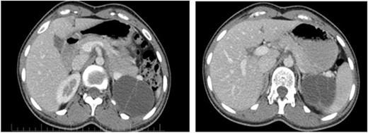 The pancreatic cystic mass appearance on the patient’s CT scan.