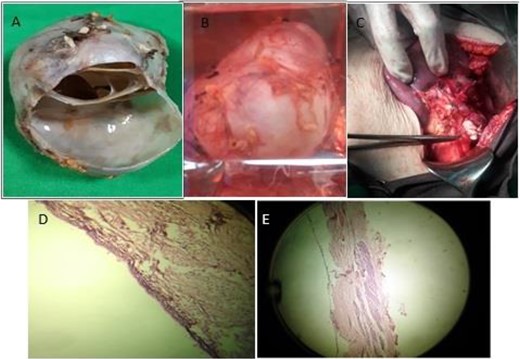 The macroscopic appearance of the pancreatic cystic mass during (A) and after surgery (B, C), and the microscopic appearance of the mass (D, E).