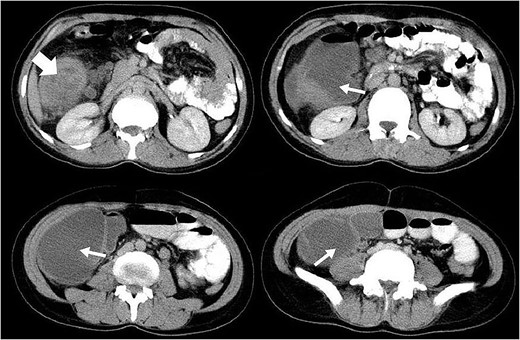 The axial CT scan slices of the case showing a target-shaped view (thick arrow) introducing intussusception and a distended obstructed colon with fluid accumulation distal to it due to a large mass of colon (thin arrows).