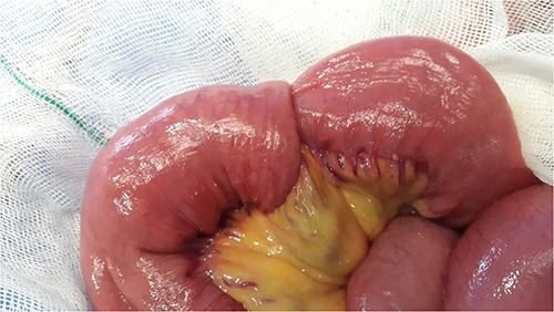 The jejunojejunal intussusception.