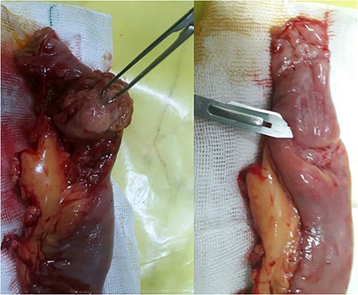 The intraluminal intestinal mass before (pointed by bisturi blade) and after dissection (grasped by Allis tissue forceps).