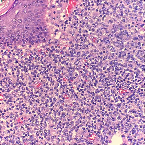 Microscopic examination reveals skin and subcutaneous tissue with atypical nodular nested lymphoid infiltrate in the dermis. H&E 40×.