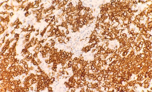 Immunohistochemical stain reveals atypical lymphoid cells are positive for CD20. IHC 40×.