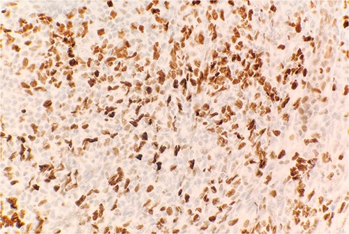 Immunohistochemical stain reveals atypical lymphoid cells are positive for BCL6. IHC 40×.