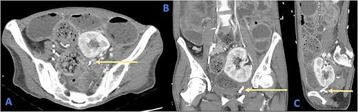 Axial (A), coronal (B), and sagittal (C) views of a CT demonstrating the position of the ureteric stent (arrows) as it crosses the rectosigmoid colon. Note the faecalization of proximal colon and dilated colonic loops.