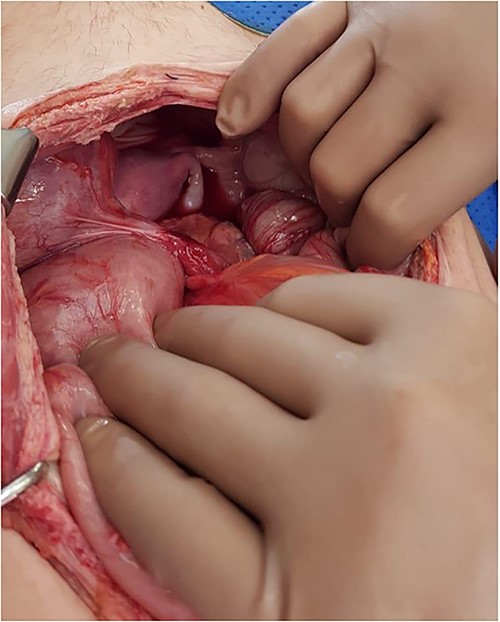 Intraoperative photo demonstrating a cord-like structure crossing over the rectosigmoid colon. This was thought to be the ureter with stent in situ.