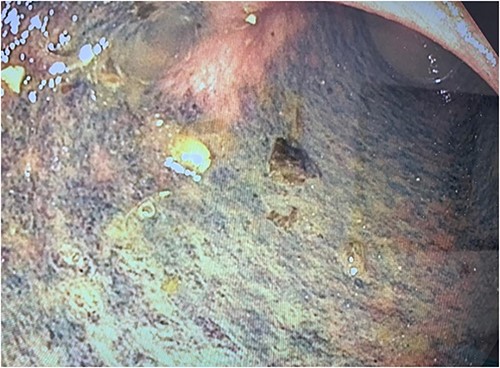 Photograph of the mucosal ischaemic changes in the part of the colon distal to the area of compression by the cord-like structure (presumably the stented ureter).