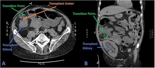 (A) Axial CT section showing transplant ureter coursing anterior to kidney transversing over the transition point of SBO. (B) Coronal CT section showing faecalized small bowel approaching transition point with gross hydroureter and hydronephrosis of transplant kidney.