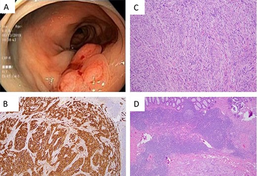 (A) Flat lesion (25 mm) with central depression in the proximal descending colon as seen on colonoscopy. (B) S100 stain 40× demonstrating sheets of strongly S100 positive cells. (C) H&E 100× spindle cells arranged in short fascicles with whirling pattern. (D) H&E 40× demonstrating prominent lymphoid cuff and diffuse lymphoid invasion.