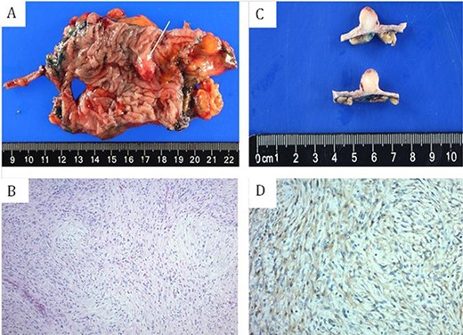 (A and C) gross surgical pathology. (B) H&E staining of spindle cells arranged in short fascicles with whirling pattern. (D) S100 staining demonstrating sheets of strongly S100 positive cells.