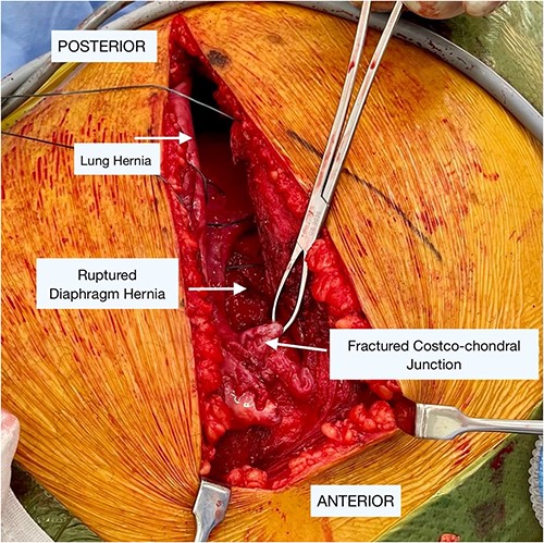 Intraoperative findings of the lung and diaphragmatic herniae as well as the fractured costochondral junction as labeled in image.
