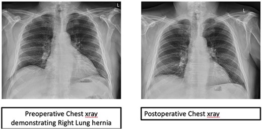 Preoperative and postoperative chest X-rays.