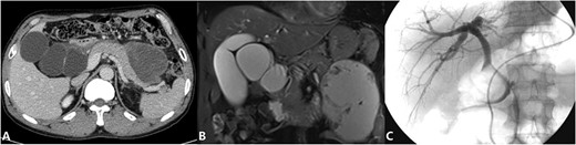 (Preoperative image) A: CT; B: MRCP; C: ERCP.