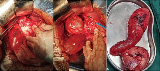(Intraoperative image) A: Gallbladder; B: Cystic Duct Cyst; C: Common Bile Duct.