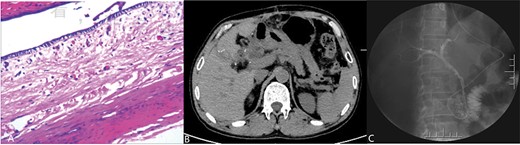 (Postoperative image) A: Pathological examination revealed a cyst with a fibrous wall, dense chronic inflammatory infiltration; B: CT after operation; C: Radiography through nose-bile tube after operation.