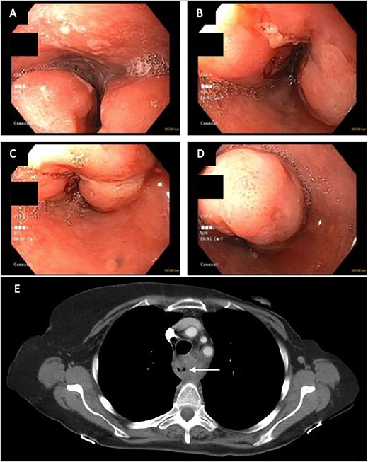 (A–D) EDG images showing circumferential esophageal mass with friable mucosa and ulcerations. (E) CT chest showing marked soft tissue thickening with luminal narrowing in the upper esophagus, which extended to a level below the carina.