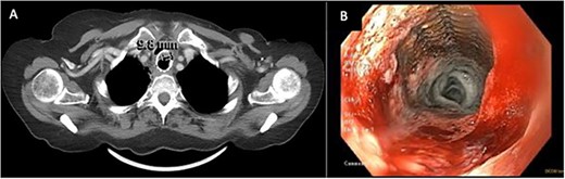 (A) CT image from January 2021 showing severe narrowing of the lumen of the esophagus proximal to the stent. (B) EDG from February2021 showing response to balloon dilation of a stricture proximal to the indwelling stent.
