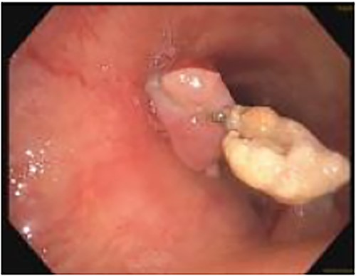 Bronchoscopic evidence of tumor growth into the trachea with evidence of stent erosion (August 2022).