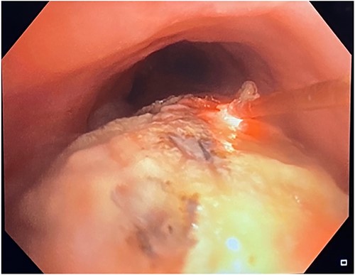 Bronchoscopic view of the endobronchial obstruction. Invasion of the esophageal malignancy can be seen, as well as erosion of the esophageal stent into the lumen of the trachea.