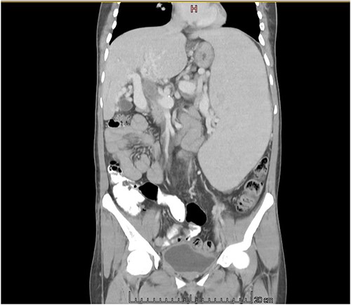 CT scan coronal view showing gross hepatosplenomegaly with large collaterals suggestive of portal venous hypertension with portal biliopathy. Chronic thrombus seen in SMV and portal confluence.