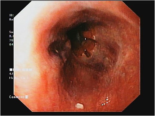 Upper GI scopes showing portal hypertension gastropathy.