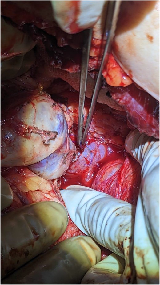 Proximal side-to-side spleno-renal shunt.