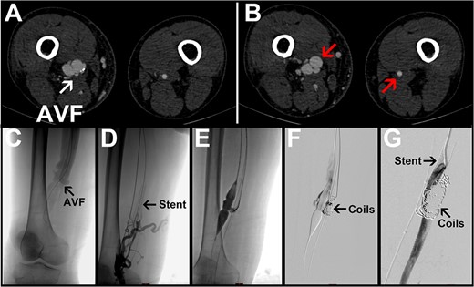 Representative images for Case 1. (A) Preoperative CTA image with the arrow pointing to an arteriovenous fistula. (B) The left arrow points to the obviously dilated right femoral artery; the right arrow points to the normal left femoral artery. (C–G) Intraoperative angiogram images. R, right side; L, left side; AVF, arteriovenous fistula.