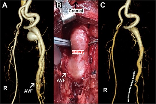 Representative images for Case 2. (A) Preoperative image with the arrow pointing to an AVF. (B) Intraoperative picture with the arrow indicating an AVF. (C) Postoperative imaging data. R, right side; AVF, arteriovenous fistula.