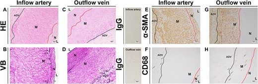 The pathology of the inflow and outflow vessels of the patient in Case 2. (A, C) Representative HE staining of the inflow and outflow vessels. (B, D) Representative Victoria blue staining of the inflow and outflow vessels. (E, G) Representative α-SMA staining of the inflow and outflow vessels. (F, H) Representative CD68 staining of the inflow and outflow vessels. ADV, adventitial layer; M, media layer; N, neointimal layer; α-SMA, α-Smooth muscle actin; VB, Victoria blue staining.