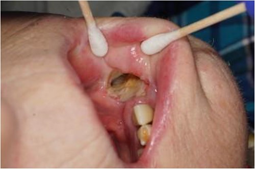 Photograph showing the full thickness intraoral component of the orocutaneous fistula with exposed fibula bone.