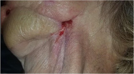 Photograph showing the cutaneous component of the orocutaneous fistula. Also, note significant scar contracture and evidence of radiation fibrosis of the skin.