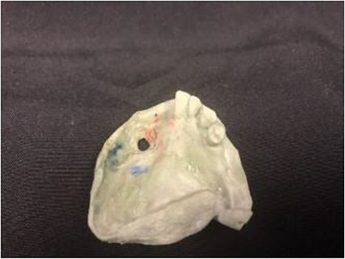 Stone model for the intraoral device with full thickness defect noted.