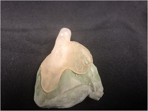 Custom tray overlying stone model prior to relining with dental impression material.