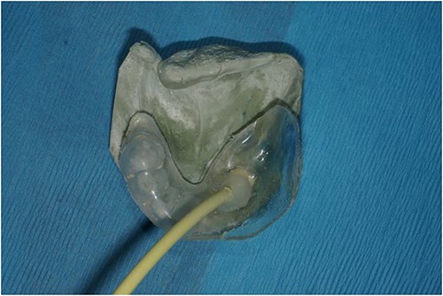 Acrylic splint with perforated area attached to tubing to attach to VAC system overlying the stone cast as it would then eventually sit within the oral cavity.