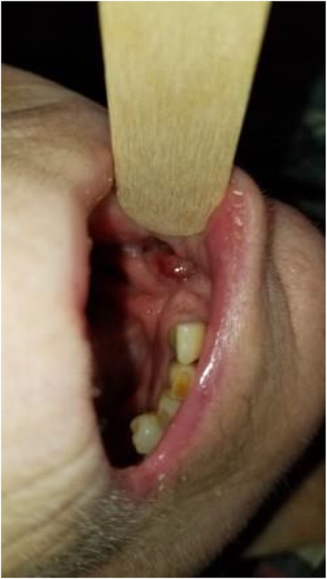 There is near complete mucosalization of the oral defect 2 weeks postinitiation of combined transoral and transcervical NPWT.