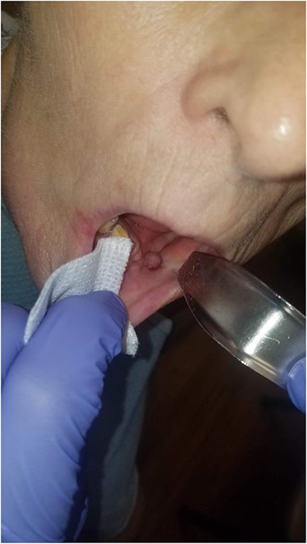 There is mucosalization of the oral defect and diminished erythema and edema of the healing wound as compared with Fig. 6 2 weeks prior.