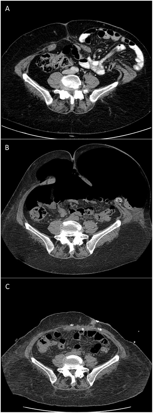 CT scans of type IV PH repair after botulinum toxin and PPP: (A) 9 months before surgery; (B) after preoperative BTA and PPP completion; and (C) 3 days postoperative.
