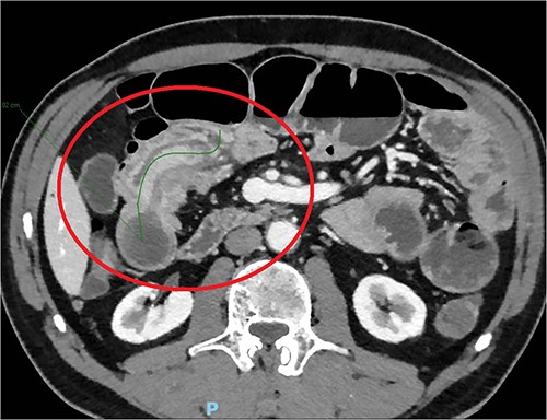 Abdominal TC with the details of intussusception.