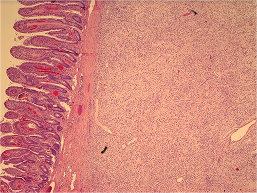 Histological image of Vanek’s tumor with intact intestinal mucosa.