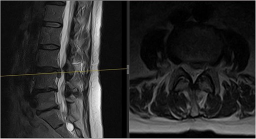 Initial MRI scan of the lumbar spine: initial MRI scan of the lumbar spine performed in July 2022 showing the left-sided L3/4 disc prolapse.