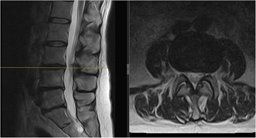 Follow-up MRI scan of the lumbar spine: follow-up MRI scan of the lumbar spine performed in March 2023 showing complete resolution of the disc prolapse.