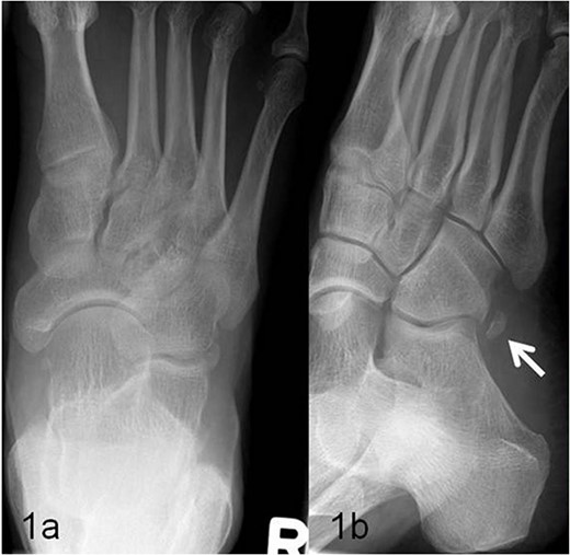 (a, b) Presentation of the os peroneum (marked with an arrow) in the oblique X-ray image.
