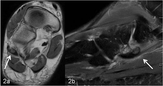 (a, b) MRI imaging, (a) axial T1 weighted slice, the os peroneum is centrally located in the long peroneal tendon (marked with an arrow). In (b) sagittal T2 weighted fat-suppressed slice, around the os peroneum (marked with an arrow) and along the tendon there is a marked signal enhancement, corresponding to inflammatory fluid accumulation (tenosynovitis).