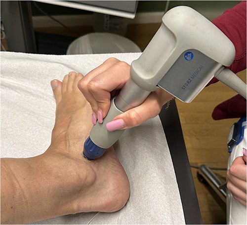 Illustration of the technical implementation of extracorporeal shockwave therapy.