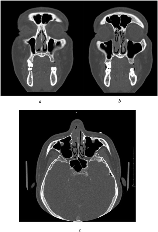 (a–c) Preoperative CT scan of paranasal sinuses with contrast. All imaged paranasal sinuses appears clear with no significant mucosal thickening or air-fluid level detected. Intact bony boundaries of the paranasal sinuses. (a, b) Coronal cut, showing clear paranasal sinuses, intact bony boundaries, and a non-enhancing soft tissue mass in the right anterior nasal cavity with poor demarcation to right inferior turbinate, attached to the cartilaginous part of nasal septum. (c) Axial cut.
