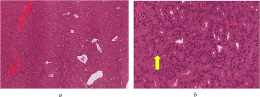 (a) Back-to-back glands with few dilated blood vessels and no intervening stroma (H&E*, original magnification ×80). (b) Compact glands with bland, monotonous, round nuclei. Arrow indicates a mitotic figure (H&E*, original magnification ×400) *Haematoxylin and Eosin.